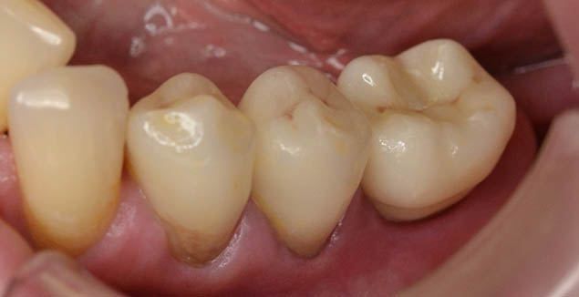 2 korunky na zubech a 1 na implantátu