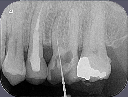 Měření kanálku horní stoličky při endodontickém ošetření