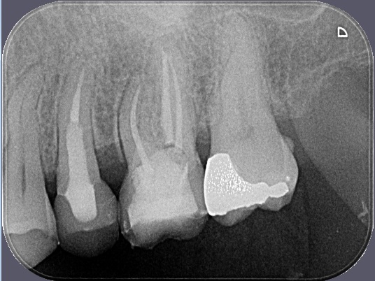 Již endodonticky zaplněná horní první levá stolička