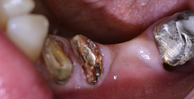 Destruované zadní zuby