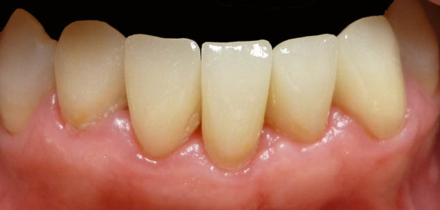 Dolní zuby po ošetření