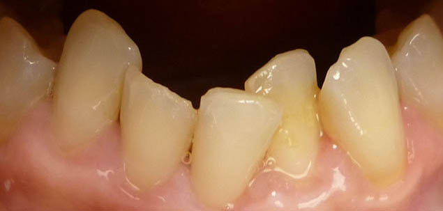 Dolní zuby před ošetřením