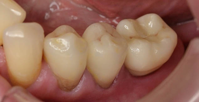 Estetická a funkční rekonstrukce zadních zubů