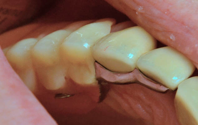 Jednostranná protéza v ústech