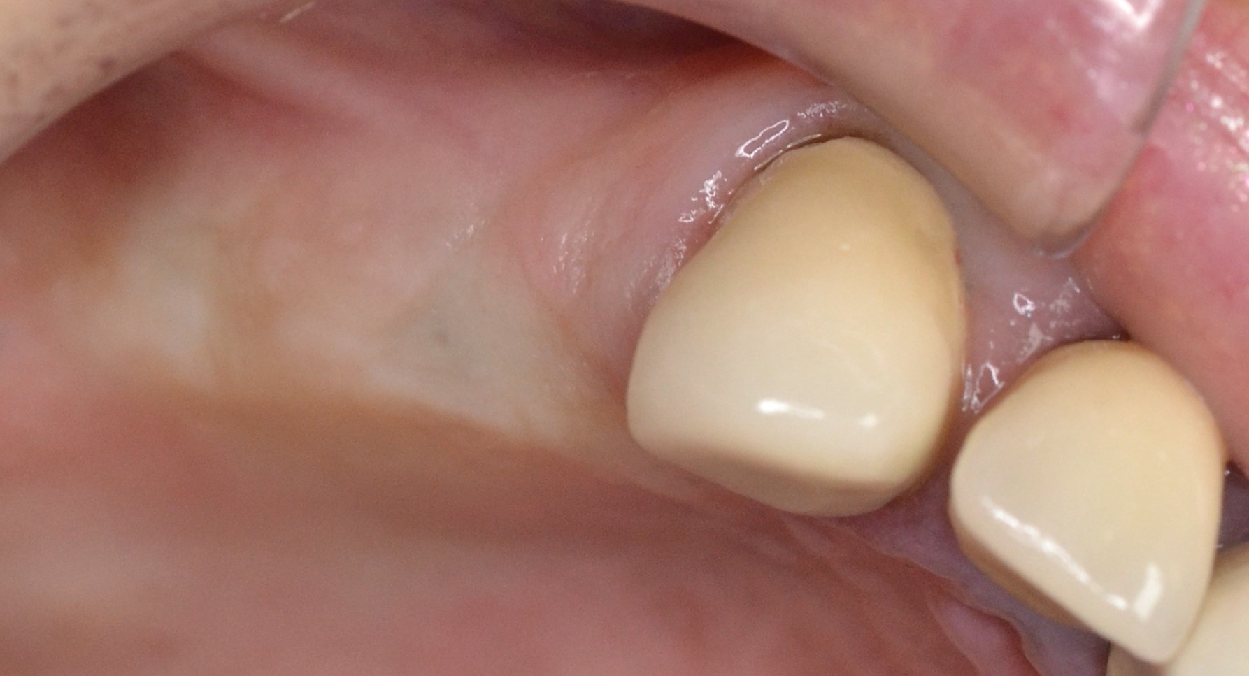 před ošetřením - chybí zuby 4 a 5