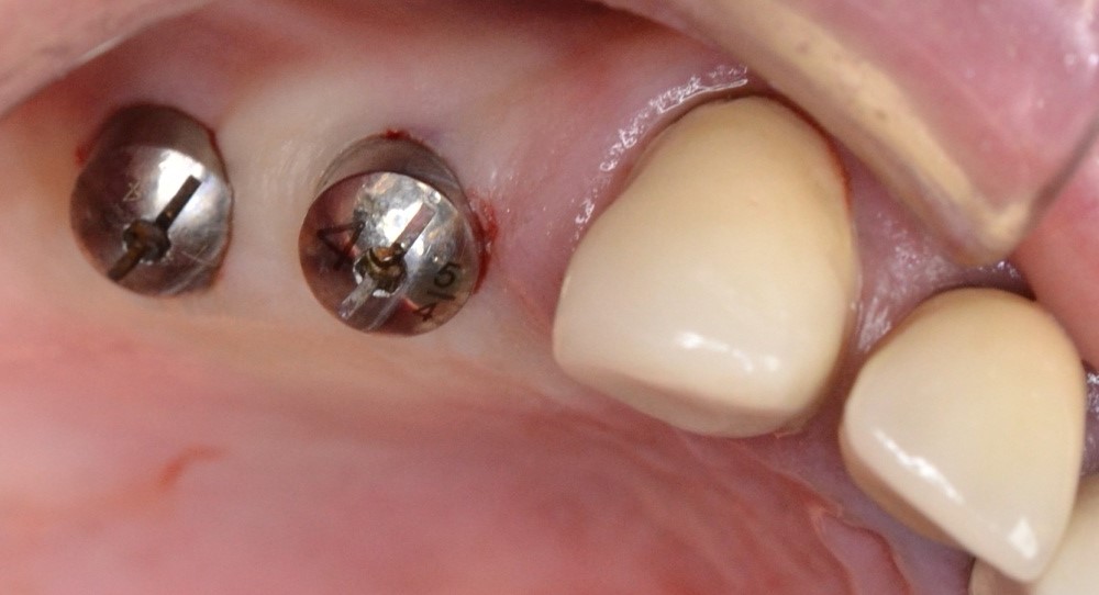 navigovaně zavedené implantáty kryté vhojovacím válečkem navigovaně zavedené implantáty kryté vhojovacím válečkem