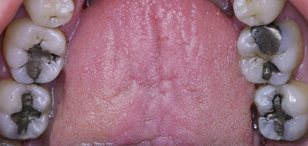 Staré amalgámové výplně Staré amalgámové výplně