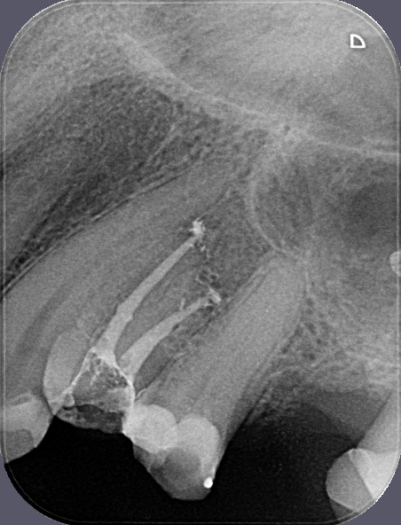 Endodonticky ošetřený zub 24