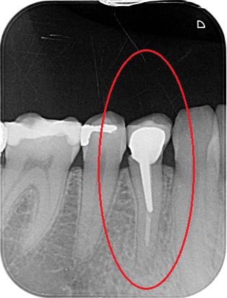 Zub léčený metodou centrálního čepu