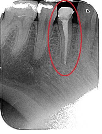 Zub léčený nadstandardní endodontickou variantou