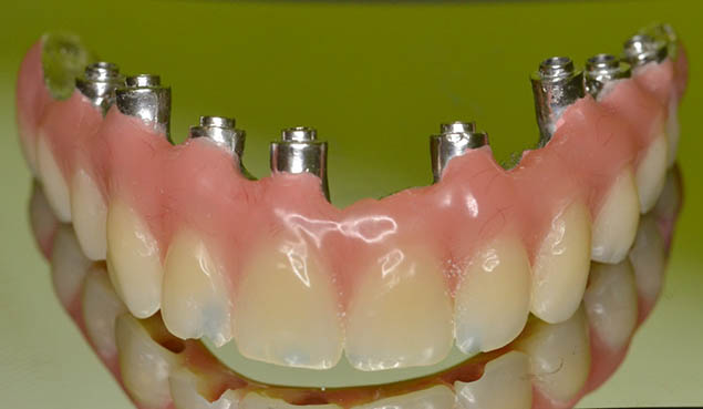 Zuby napevno nesené implantáty